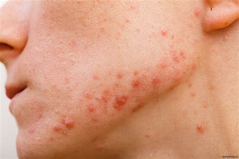 Detailná fotografia tváre s jemným začervenaním, naznačujúca akné