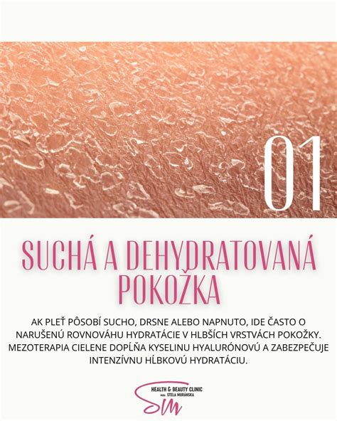 Ilustrácia znázorňujúca štruktúru pokožky a vplyv hydratácie