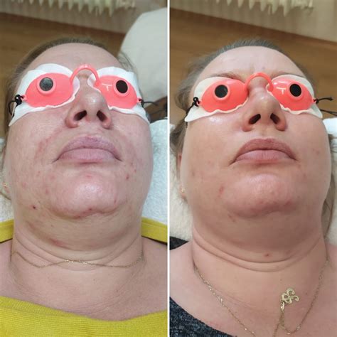 fotka žiarivej pleti po použití peelingu a následnej starostlivosti