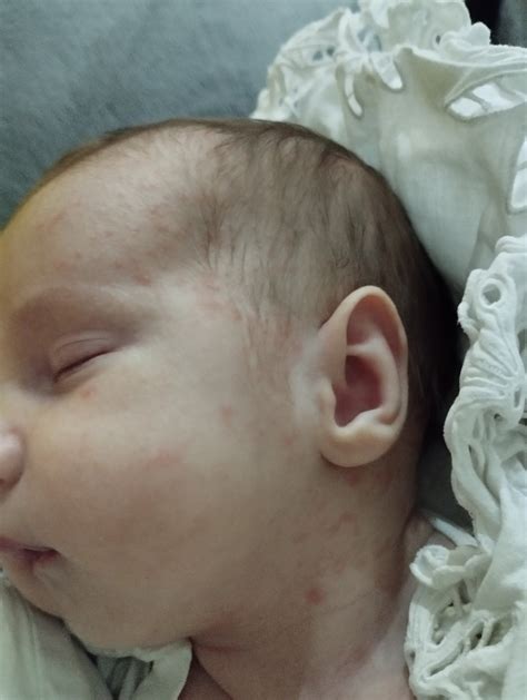 fotografia dieťaťa s atopickým ekzémom na tvári a krku