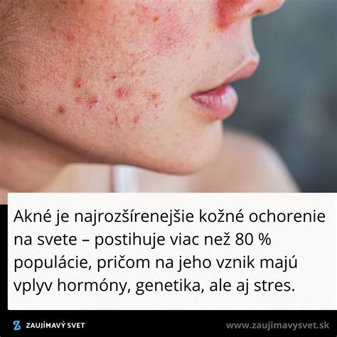 Schéma vzniku akné: upchatý vlasový folikul, nadmerná tvorba kožného mazu a zápalový proces v pokožke.