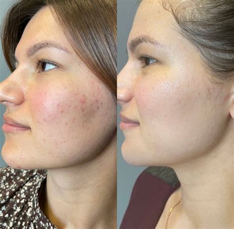 Infografika zobrazujúca princíp fungovania IPL terapie na akné