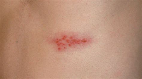 Infografika zobrazujúca najčastejšie oblasti výsevu herpes zoster a rizikové zóny na tvári.