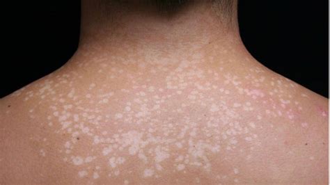 Fotografia príkladov bielych škvŕn na koži (hypomelanóza a tinea versicolor)
