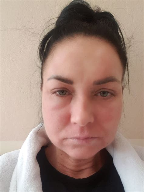 foto prejavov mokvajúceho ekzému