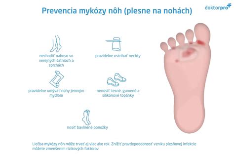 Priedušná obuv a bavlnené ponožky ako prevencia mykózy