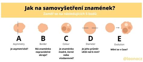 Ilustrácia: Pravidlo ABCDE na rozpoznanie melanómu