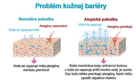 Informačná grafika zobrazujúca kožnú bariéru u zdravej pokožky vs. pokožky s atopickou dermatitídou