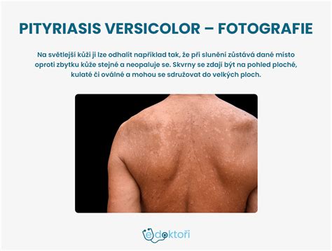 Infografika znázorňujúca vplyv potenia a kožného mazu na rozvoj kvasinky Malassezia