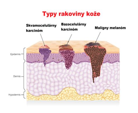 Ilustrácia rôznych typov melanómu na koži