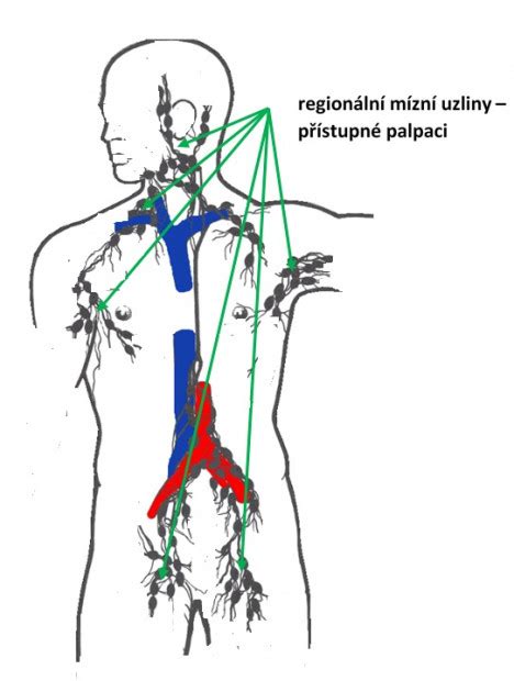 Schéma biopsie sentinelovej uzliny