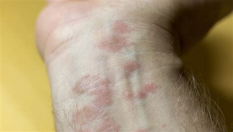 Fotografia psoriatických ložísk na koži, typické červené škvrny so striebornými šupinami.