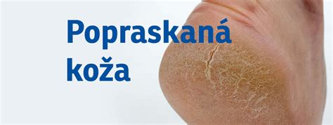 ilustrácia príznakov suchej pokožky na nohách (šupinatenie, praskliny)