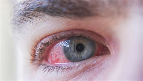 Ilustračná fotografia zdravej pokožky s jemným začervenaním, naznačujúca mierny zápal.