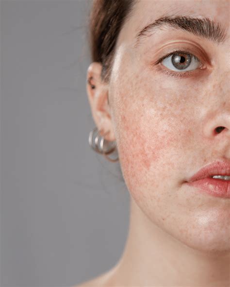 Ilustračná fotografia tváre s príznakmi rosacey - začervenanie a rozšírené cievky