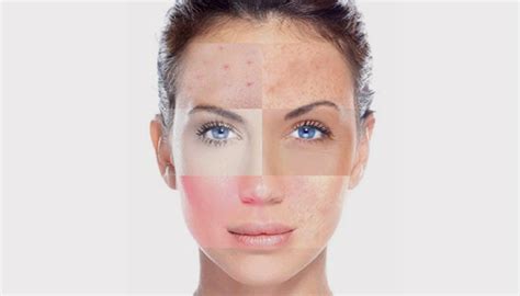 Infografika znázorňujúca rôzne typy pleti a špecifické rady produktov La Roche-Posay pre ich ošetrenie