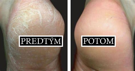 detailný pohľad na popraskanú pokožku rúk s viditeľnými mikrotrhlinami v oblasti kĺbov
