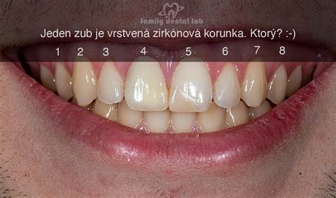 Schéma zobrazujúca rozdiel medzi zdravou pleťou a pleťou s atrofickými jazvami.