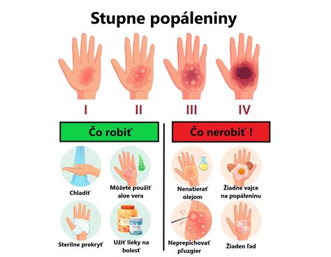 Ilustratívne foto popálenín rôzneho stupňa a ich hojenia