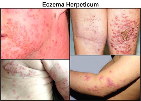 Schéma: Prejavy Eczema herpeticum