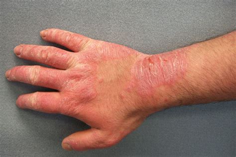 Thematic photo of skin affected by contact dermatitis