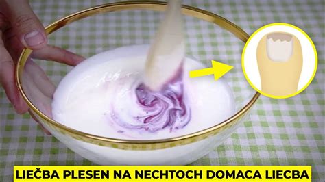 Príklad plesne na nechtoch.