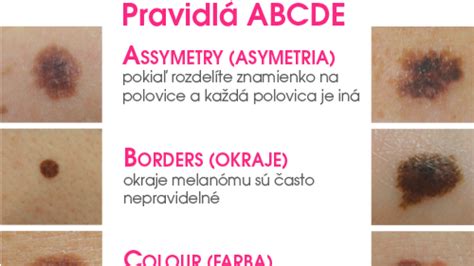 Ilustrácia pravidla ABCDE pre samovyšetrenie znamienok