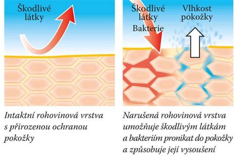 infografika - rozdiel medzi suchou pokožkou a lupinami