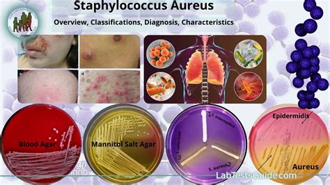 Infografika: Prehľad foriem infekcií Staphylococcus aureus
