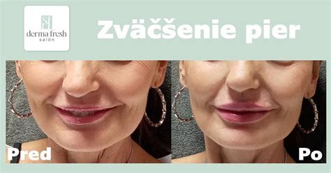 Fotografia plných, prirodzene vyzerajúcich ženských pier po aplikácii výplní