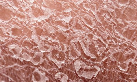 Tematická fotografia: pokožka s rôznymi kožnými ochoreniami, ako sú ekzém alebo psoriáza
