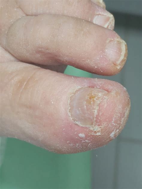 Detailné zobrazenie nechtu postihnutého mykózou (zhrubnutie, zmena farby)