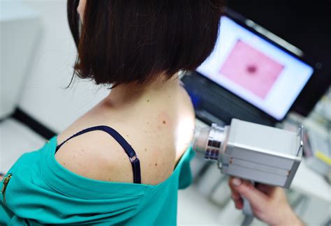 ilustračné foto: vyšetrenie pokožky dermatoskopom