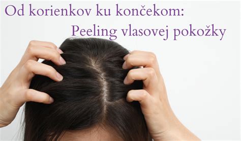 Ilustračná fotografia zobrazujúca detail vlasovej pokožky s viditeľnými príznakmi podráždenia alebo začervenania.