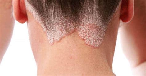 Infografika porovnávajúca príznaky a charakteristiky rôznych ochorení pokožky hlavy, ako sú atopická dermatitída, seboroická dermatitída, psoriáza a kontaktná dermatitída.