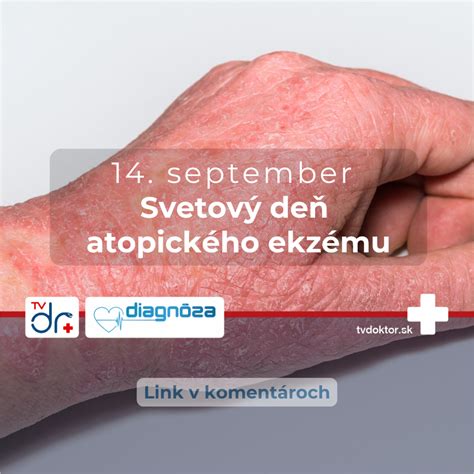 Schéma narušenej epidermálnej bariéry pri atopickom ekzéme