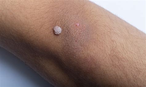 Schéma kože s vyobrazením bradavice spôsobenej HPV infekciou