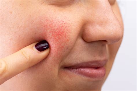 ilustrácia rozdielov medzi akné a všeobecnou vyrážkou