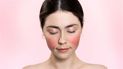 Motýľovitá vyrážka na tvári typická pre lupus