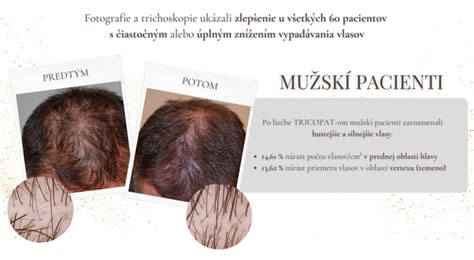 infografika: porovnanie mužskej a ženskej androgénnej alopécie
