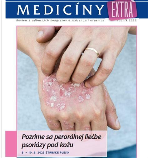 Schéma rôznych prístupov k liečbe psoriázy (lokálna, fototerapia, systémová)