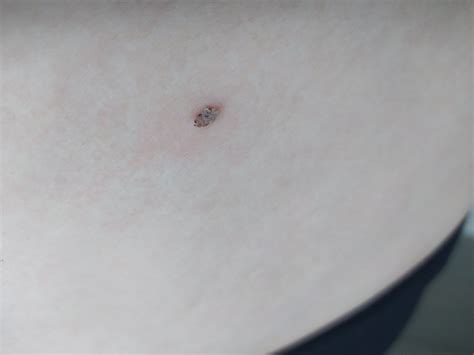 Tematická fotografia: Ruka lekára drží dermatoskop a vyšetruje znamienko na koži pacienta