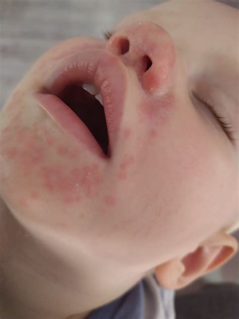 Schéma: Prejavy periorálnej dermatitídy v oblasti úst a nosa