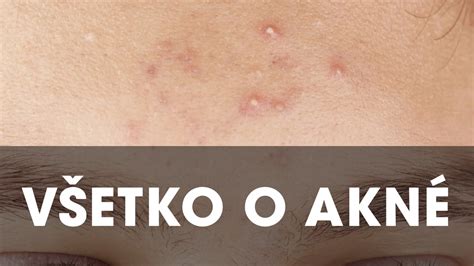 Schéma vzniku akné: upchatie pórov, zápal, baktérie