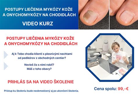 infografika s príznakmi onychomykózy na nechtoch