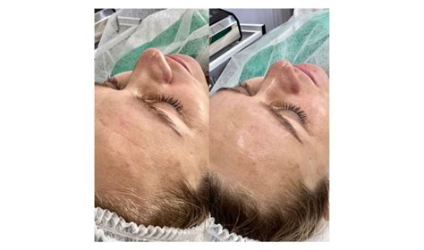 Zariadenie DermaOXY s dvomi ošetrujúcimi hlavicami