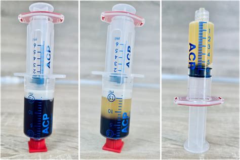 Ilustračná fotografia znázorňujúca proces prípravy a aplikácie PRP plazmy.