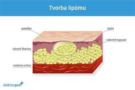 Schéma: Porovnanie vlastností lipómu a liposarkómu (rast, pohyblivosť, bolesť)