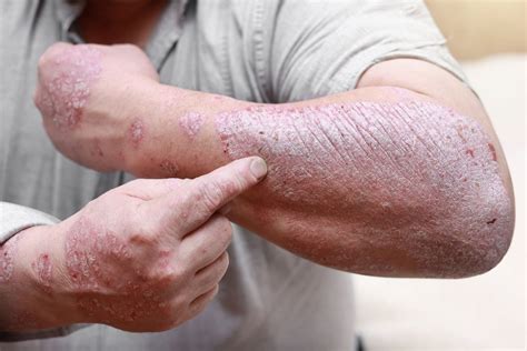 Tematické foto: Rôzne kožné ochorenia ako psoriáza a ekzém