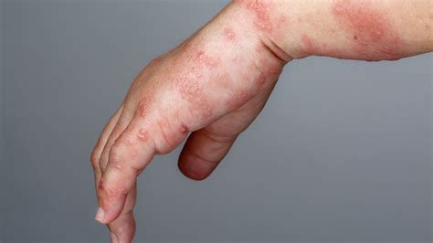 Tematické foto: koža postihnutá seboroickou dermatitídou